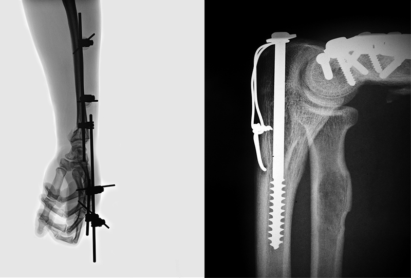 生物医疗突破：陶瓷 3D 打印机定制骨植入体的临床应用
